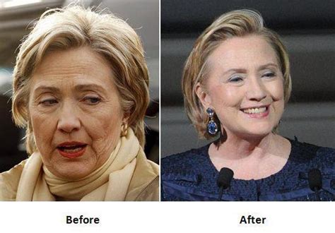 Hillary Clinton Face Lift Surgery Before And After Photos