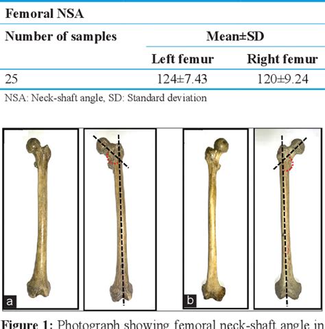 Morphometric Study Of Femoral Neck Shaft Angle And Its Implications