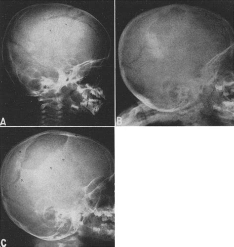 Leptomeningeal Cysts Of The Brain Following Trauma With Erosion Of The