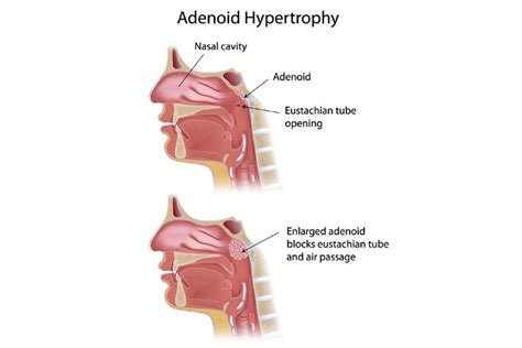 Enlarged Adenoids In Children Symptoms Removal And Treatment