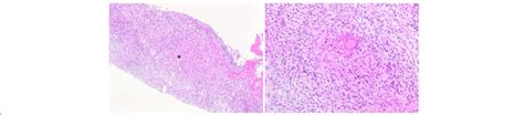 Histopathological Examination Granuloma Formation With Caseous