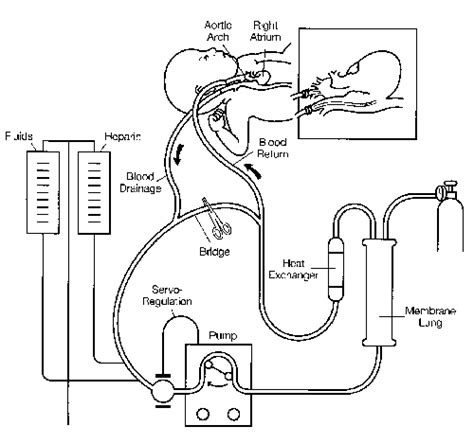 Diffusion Of Extracorporeal Membrane Oxygenation Ecmo Report Of The