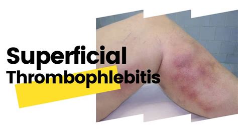 Superficial Thrombophlebitis Information Vein Solutions