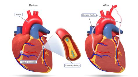 Benefits Of Cabg Surgery Coronary Artery Bypass Grafting Cardiac