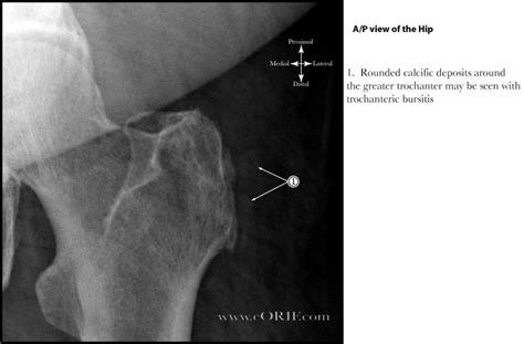 Trochanteric Bursitis Mri