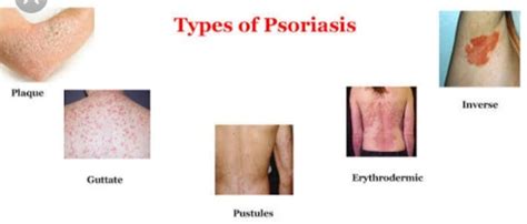 Psoriasis Symptoms Causes And Treatment Santripty