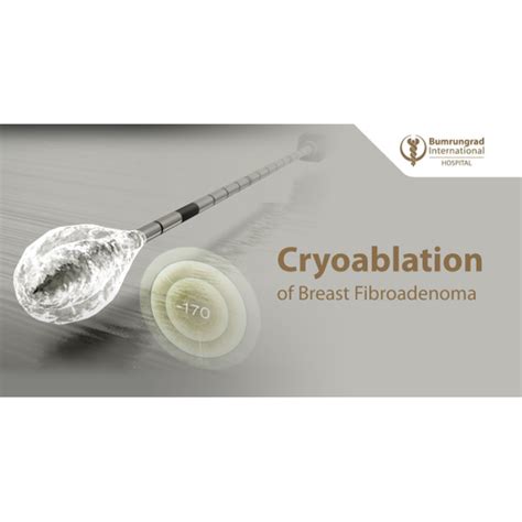 Cryoablation Treatment Of Breast Fibroadenoma Medical And Healthcare