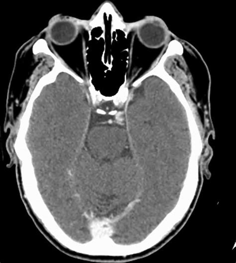 Pre Operative Ct Scan With Iv Contrast Showing A Nodular And Homogenous