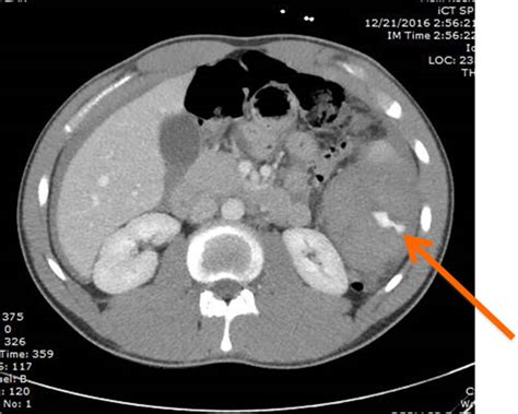 An Update On Nonoperative Management Of The Spleen In Adults Trauma
