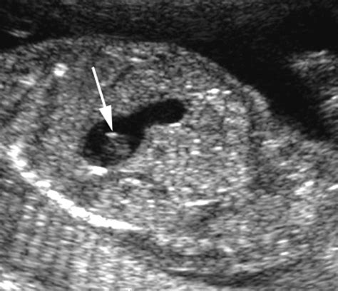 Intraabdominal Fetal Echogenic Masses A Practical Guide To Diagnosis