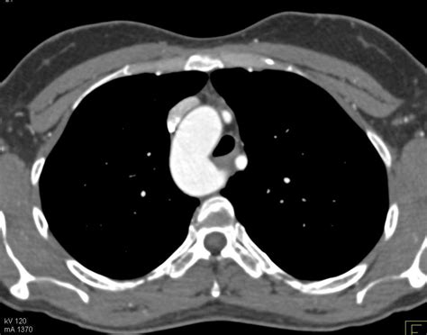 Right Aortic Arch Chest Case Studies Ctisus Ct Scanning