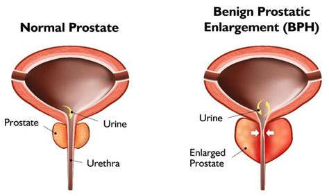 How Is A Enlarged Prostate Treated