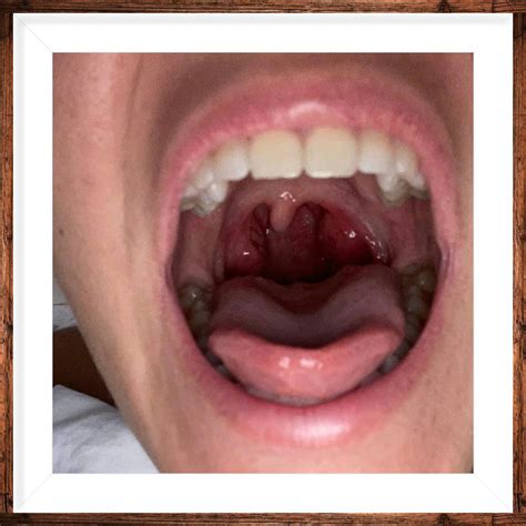 Big Sore Looking Tonsils Cause Snoring Recurrent Sore Throats Bad