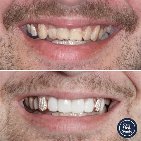 Smile Makeover 68 Cosmedismile