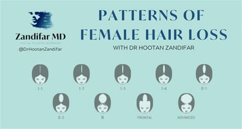 Female Pattern Baldness Female Hair Loss Patterns And Treatment