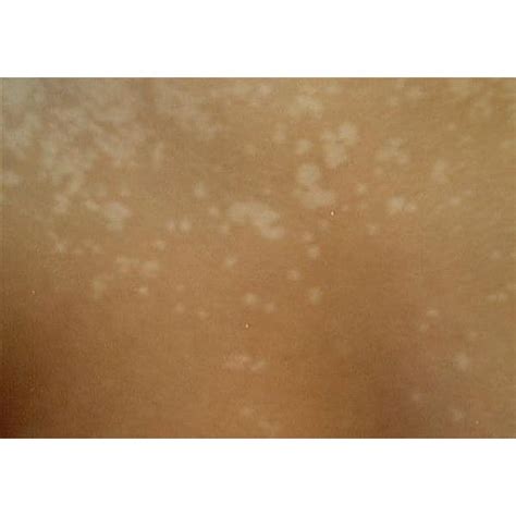 How To Get Rid Of Tinea Versicolor Pityriasis Versicolor Skin