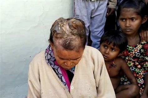 Woman Surprises Doctors After Growing Horns On Her Head Wales Online