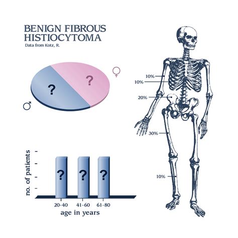 Benign Fibrous Histiocytoma