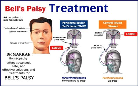 Bells Palsy Treatment Guidelines 2020 The Role Of Rehabilitation In Peripheral Paralysis Of