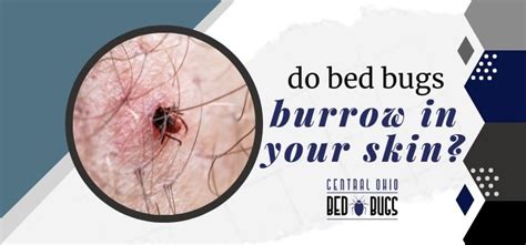 Do Bed Bugs Burrow In Your Skin Answered