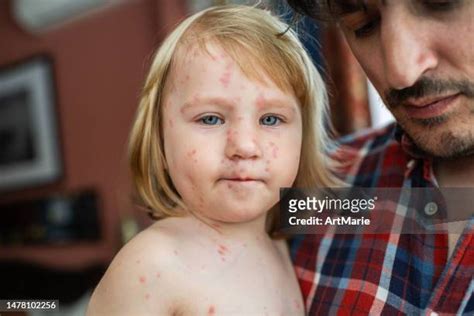 Severe Skin Infection Photos And Premium High Res Pictures Getty Images