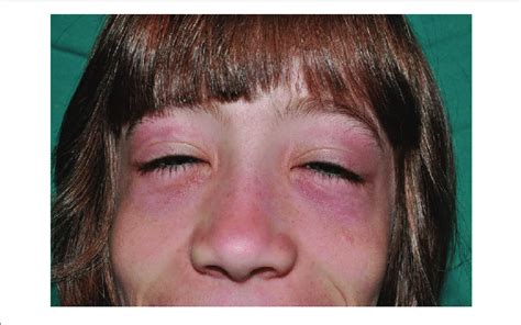 Periorbital Erythema And Edema And Flat Nose In A Patient With Candle