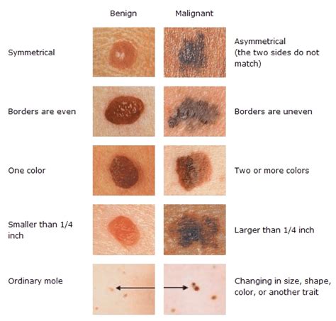 Images Showing Comparison Between Benign And Malignant Skin Lesion