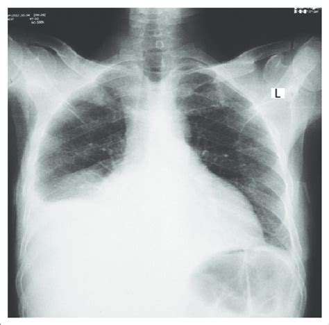 Chest X Ray Showing A Right Pleural Effusion Due To Kaposis Sarcoma