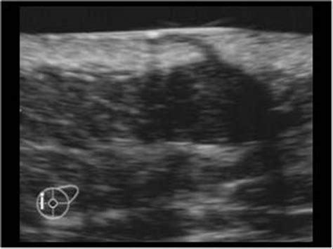 Ultrasound Imaging Ultrasound Study Of Sebaceous Cyst