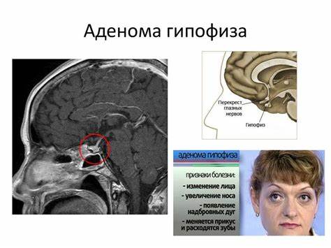 Мр картина микроаденома гипофиза - 90 фото Картинка - Мр картина микроаденома гипофиза - 90 фото