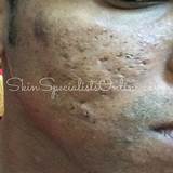 Pictures of Ice Pick Acne Scars