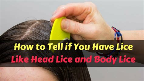 How To Tell If You Have Lice Like Head Lice And Body Lice Youtube