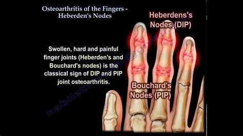 Osteoarthritis Of The Fingers Heberden S Nodes Everything You Need To Know Dr Nabil
