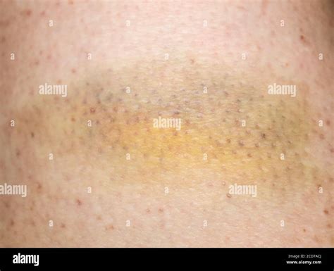 Large Bruise Hematoma On The Humans Leg On The Skin In Different Colors