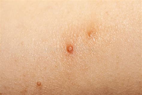 Close Up Of Molluscum Contagiosum Also Called Water Wart Stock Image Image Of Infection Rash