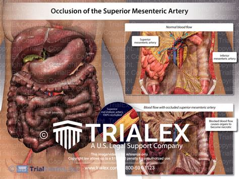 Occlusion Of The Superior Mesenteric Artery Trial Exhibits Inc