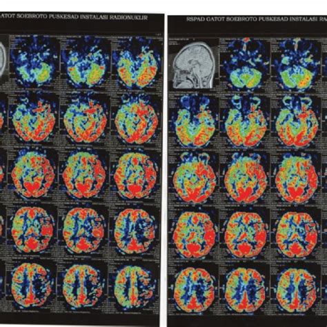The Perfusion Image Compared Brain Perfusion Before Left And After