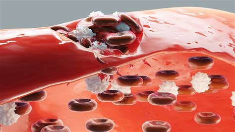 Blood Clot Research Opens Door To Better Understanding Of Wound Repair
