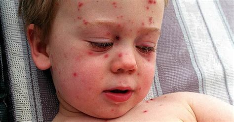 41000 Measles Cases Hit Record High In Europe 9gag