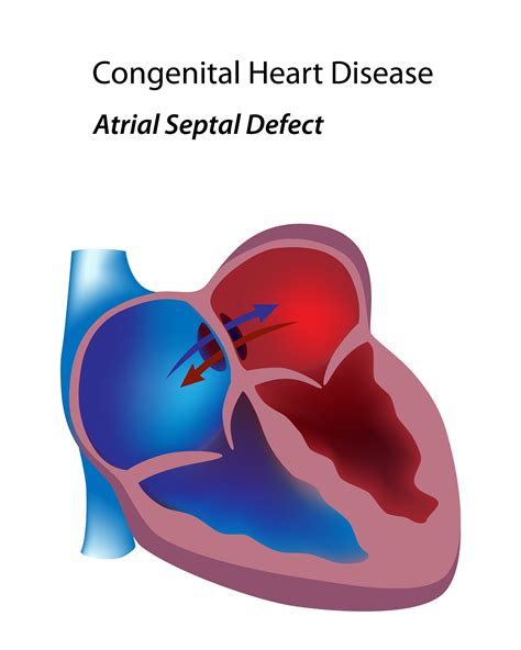 Congenital Heart Disease Atrial Septal Defect The Pulse