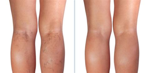 Before And After Varicose Vein And Spider Vein Treatment San Diego