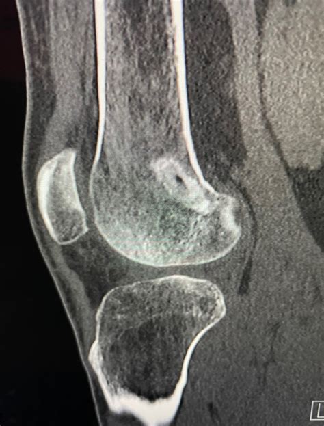 Revision Acl Reconstruction Using Bone Allograft Ct Images Showing