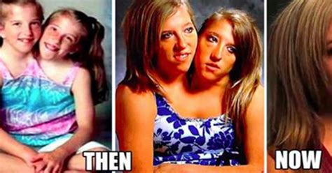 Unusual Facts About Famous Conjoined Twins Abby And Brittany Hensel