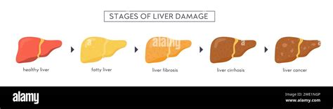 Stages Of Nonalcoholic Liver Damage Healthy Fatty Steatosis Nash