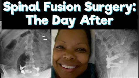 Spinal Fusion Surgery The Day After 6321 Youtube