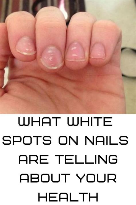 What White Spots On Nails Are Telling About Your Health White Spots