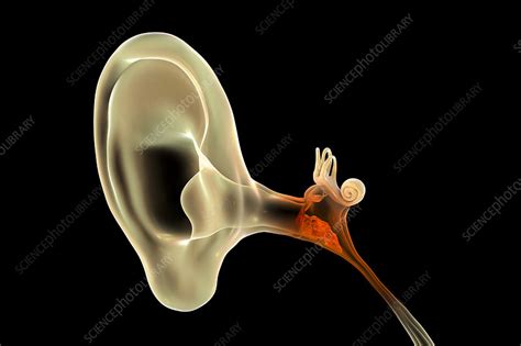 Otitis Media Ear Infection Illustration Stock Image F0325954