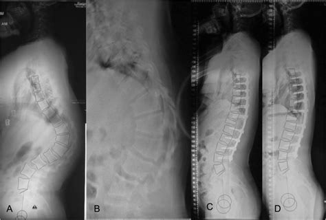 Typical Severe Scheuermann Thoracolumbar Kyphosis Stlk Case Receiving