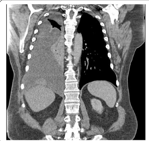 Ct Chest Transverse View Displaying Right Sided Pleural Mass Associated
