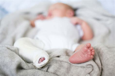 What Should You Do If Your Baby Has Clubfoot